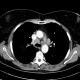 Lung sarcoidosis: CT - Computed tomography